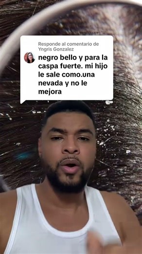 HOME REMEDY FOR DANDRUFF