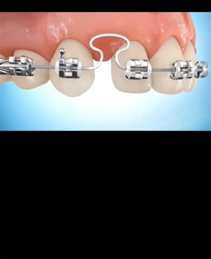 How closing loops work in orthodontics