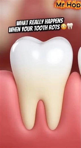 What Really Happens Inside Your Tooth When It Starts to Rot 😳🦷
