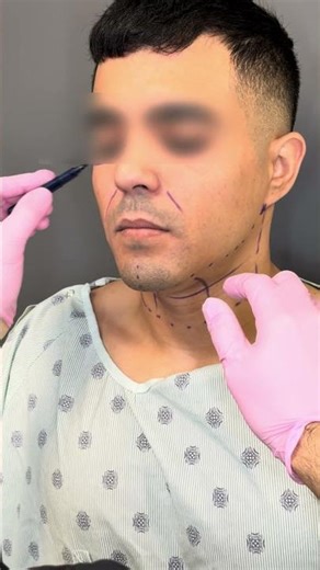 Massive Weight Loss Transformation | Facial Surgery with Dr. Morad Askari