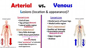 Arterial Ulcers vs. Venous Ulcers for PVD