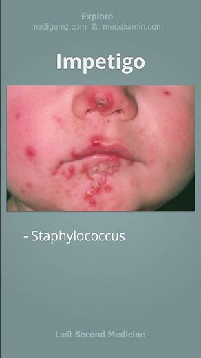 Impetigo - What is it and what is the treatment? #shorts