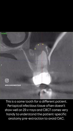 How do we minimize oroantral communication (OAC) when extracting maxillary molars?