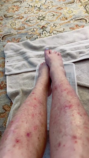 Mystery illness#fyp#leg #mystery #beach#nodiagnosisnoillness #nodiagnosis #helpme #help#doctorsoftiktok