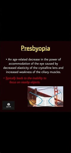 Refractive errors Ophthalmology. #usmle #eyes #ophthalmology