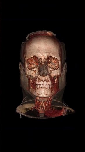 New features of Inobitec DICOM Viewer 2.12