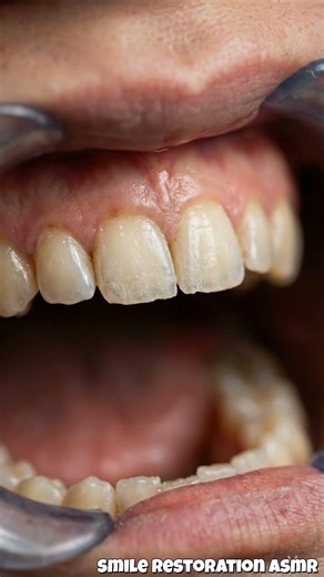 Rough Teeth Made Perfect! Dental Transformation #dentist #dental #satisfying #beforeafter #asmr
