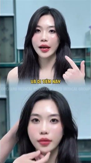 Căng chỉ kết hợp với filler quá thần thánh