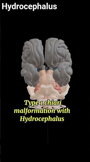 Type1 chiari malformation with hydrocephalus #pathology#3danimation#1millionviews#viralvideo