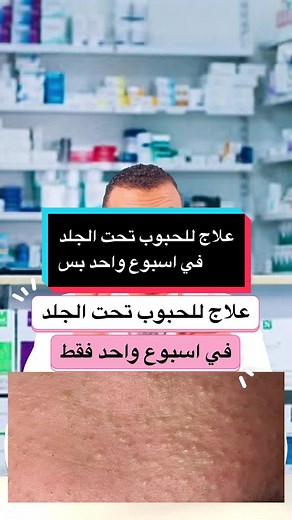 علاج للحبوب تحت الجلد في اسبوع واحد