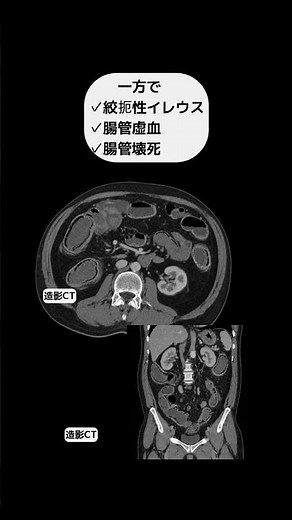 Pneumatosis Intestinalis #radiology #diagnosticimaging #shorts