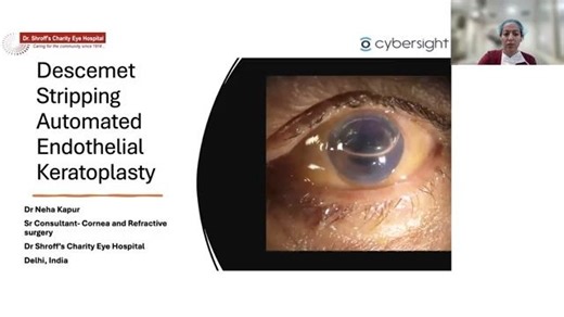 Live Surgical Demo: DSAEK Indications and Techniques - 手术直播：角膜内皮移植术DSAEK