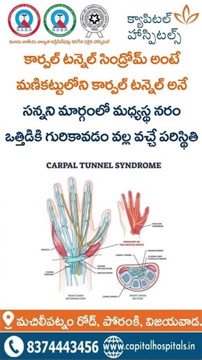 Carpal Tunnel Syndrome – Symptoms, Causes & Treatment Explained | Capital Hospitals