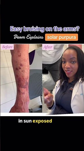 Easy bruising on the arms? It might be solar purpura. Dermatologist explains. #laser #solarpurpura