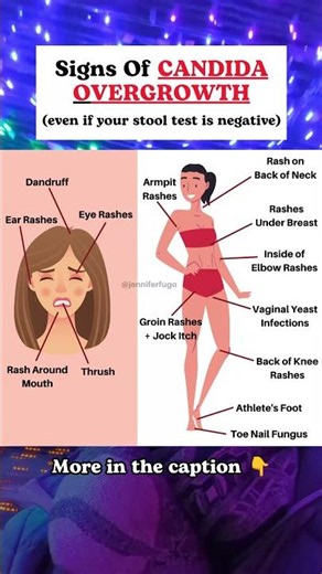 Signs Of Candida Overgrowth 🤯 #shorts