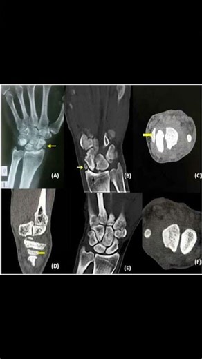 Radial Styloid Ossicle Explained 🦴 #anatomy #wristpain #radiology #ortho #sportsmedicine #physio