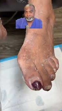 Dry Skin of the Feet #podiatry #feet #dryskin #diabetes