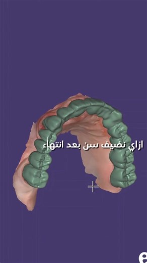 Essential Exocad Tips for Dental Technicians