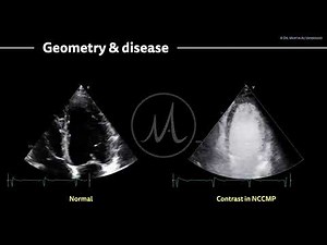 〖Echocardiography〗 Non-compaction & the left ventricle