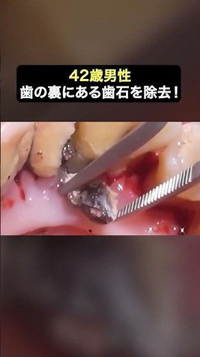 20年以上溜まった大量の歯石をスッキリ除去✨