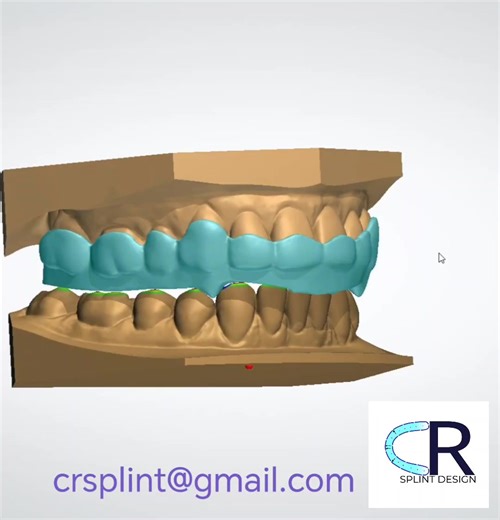 Turning complex TMJ kinematics into predictable CAD designs. ✅ Simultaneous posterior contacts (Centric Relation) ✅ Immediate posterior disclusion ✅ Perfect blockouts for a satisfying snap-fit ​Taking on new B2B partners (Dental Labs & Clinics). Let’s elevate your splint workflow! 📥 DM or email: crsplint@gmail.com ​#DentalTech #DigitalLab #MAGO #DentalDesign #3Shape #Exocad | CR Splint Design