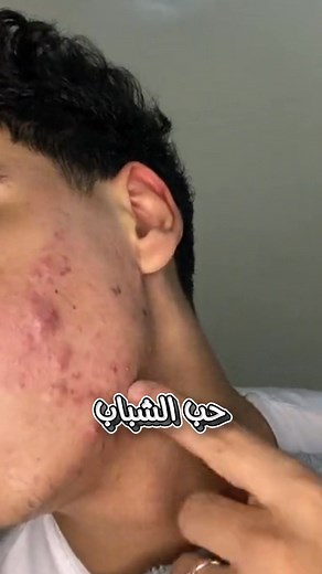 ⛔ خويا… حتى وقتاش تبقى مخبي وجهك؟ حب الشباب ماشي رجولة… النظافة هي الرجولة! 🔥 كريم **ANIAZ** رجّال بزاف: ✔ ينشف الحبوب بسرعة ✔ ينقّي البشرة من الدهون ✔ يخفف العلامات ويخلي وجهك صافيي رجّع ثقتك… وخلي وجهك يهدّر عليك. | Aniaz Cream Algeria