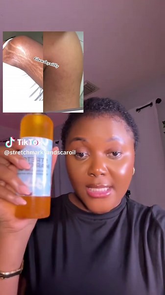 Effective Remedies for Natural Stretch Marks