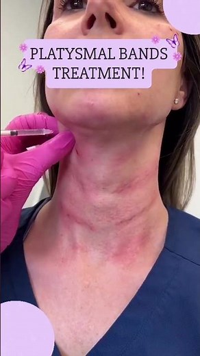 Platysmal Bands Treatment