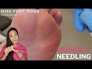Effective Plantar Wart Treatment | Needling Procedure