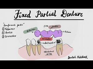 Fixed Partial Denture: Step-by-Step Guide for Perfect Smile Restoration