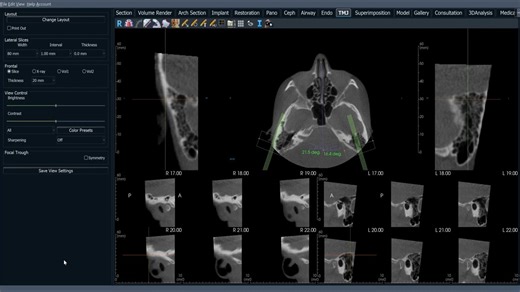 Training： The Invivo TMJ Tab