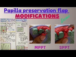Follow my secret study tricks to remember modifications of papilla preservation technique.