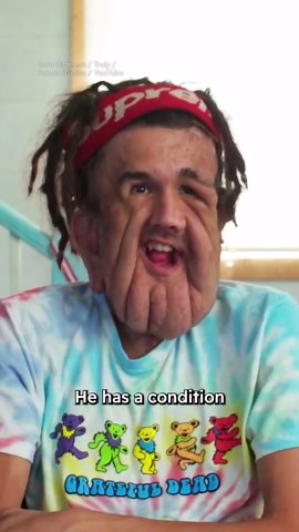 I had surgery to remove my facial flaps