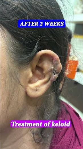 Keloid surgery/ keloid treatment/ kan me ganth kyun Hota he/ Dr Uttam Lenka