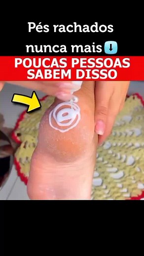 Effective Home Remedy for Treating Calluses on Feet