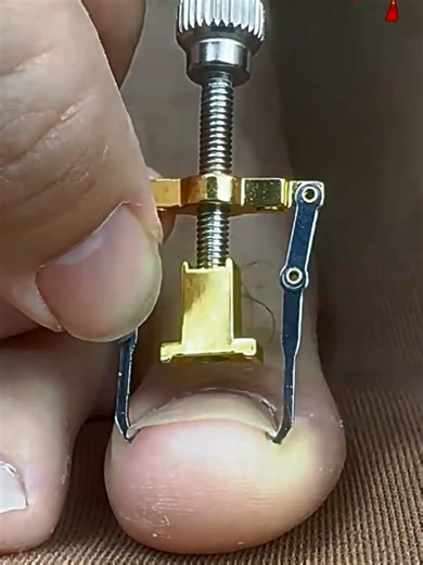 Safe Methods for Correcting Ingrown Big Toe Nails