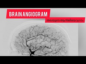 Brain Angiogram DSA Aneurisam Stroke