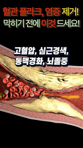 혈관 플라크제거! 염증 제거! 막히기 전에 이것 드세요!