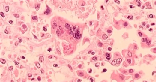 Measles case identified in 1-year-old Ingham County girl, 5th Michigan case of 2025