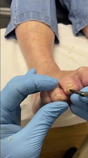 Ultimate Thick Toe Callus Removal Transformation #Podiatrist #FootCare