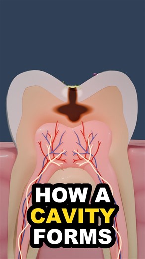 How a Cavity Forms Inside Your Tooth 🦷 (3D Animation)