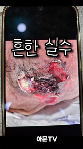 Common Bedsore Mistakes (Dressing, Repositioning, Surgery, Disinfection, Treatment, Seoul Amoon P...