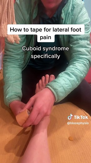 Cuboid Syndrome Management and Taping Techniques