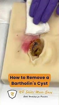 How to drain a Bartholins Cyst #shorts