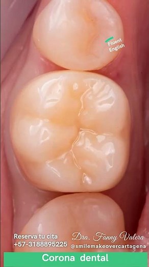 Corona dental de zirconio, proceso completo. Dra Fanny Valera Odontologa Cartagena