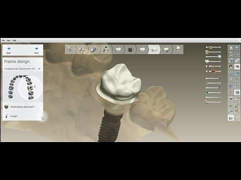 How to design an Anatomical Abutment in 3Shape