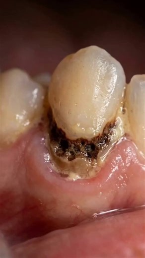 There’s many people with teeth decay but this one amazed me with the worst ever teeth decay, but guess what he meet the greatest of the greatest doctors and he smiles and brightens the surrounding 😂😱