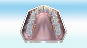 Patients in the developing permanent dentition often require arch expansion. The Farrell Bent Wire System™ (BWS) technique is ideal for this as it allows for breathing and myofunctional correction to be made in conjunction with arch development. | Myofunctional Research Co.