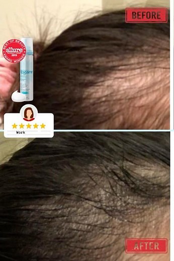 Rogaine Women's 5% Minoxidil Foam for Thinning Hair & Loss, Topical Once-A-Day