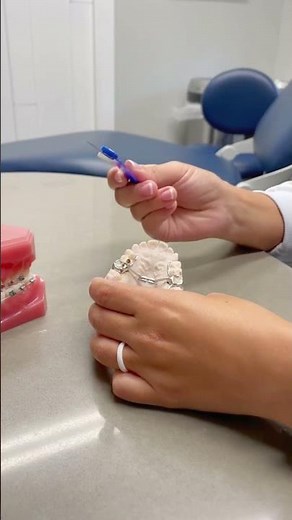 Treating A Crossbite With A Palate Expander